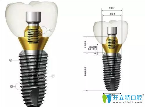 韓國(guó)登騰種植體解剖圖