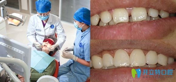 新鄉(xiāng)拜博口腔全瓷牙貼面修復(fù)效果圖 新鄉(xiāng)拜博口腔全瓷牙貼面修復(fù)效果圖