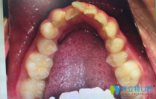 牙弓狹小需要擴(kuò)弓的病例圖
