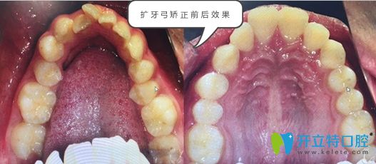 擴(kuò)弓矯正的前后效果對(duì)比圖