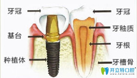 牙槽骨與種植牙圖解