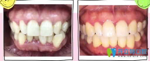 <!--<i data=20240703-sp></i>-->英博口腔牙齒擁擠不齊、咬合錯(cuò)亂矯正案例