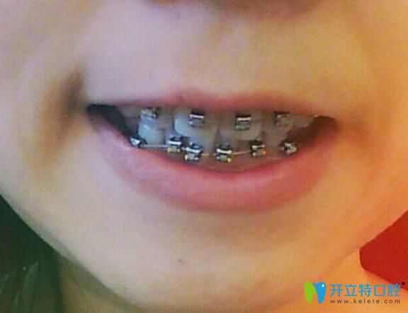 我在鄭州拜博口腔剛戴牙套