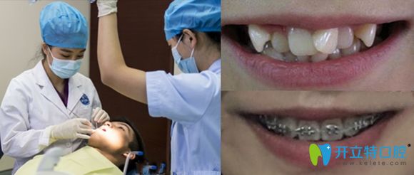 新鄉(xiāng)拜博口腔牙齒矯正案例效果圖 新鄉(xiāng)拜博口腔牙齒矯正案例效果圖