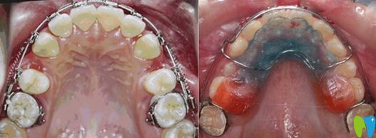 牙齒矯正擴(kuò)牙弓和拔牙對(duì)比圖