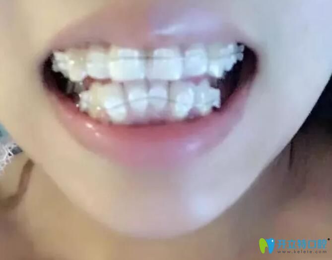 矯正擁擠不齊牙齒初戴陶瓷半隱形牙套