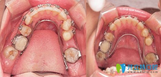 牙齒擴(kuò)弓矯正后會(huì)反彈嗎