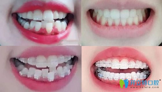 <!--<i data=20240703-sp></i>-->口腔整牙案例前后效果對比圖