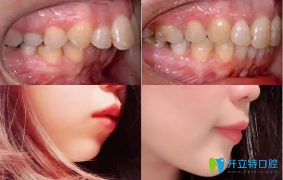 西安中諾口腔牙齒矯正案例效果