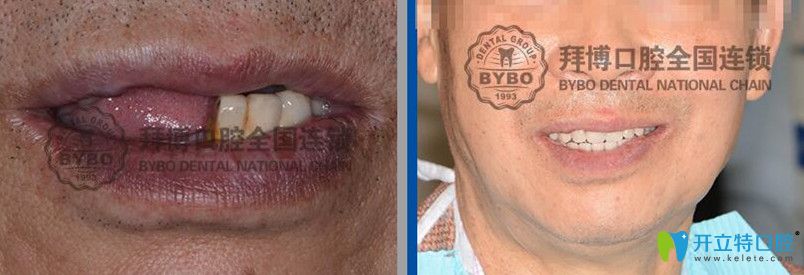 拜博口腔全口牙即刻負(fù)重種植案例前后效果對比