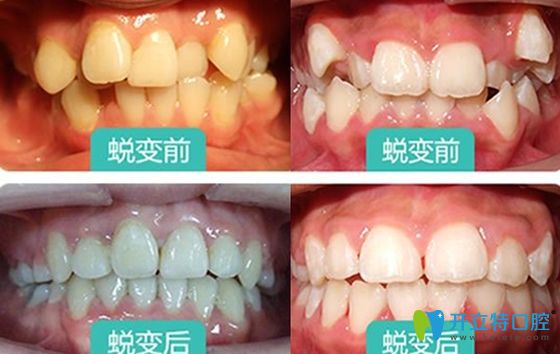 <!--<i data=20240703-sp></i>-->口腔牙齒矯正前后效果圖