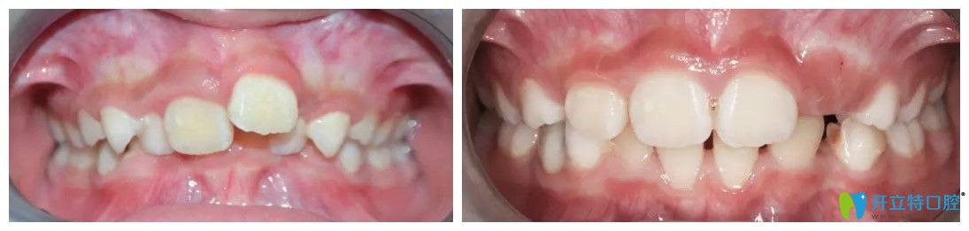 超龍牙博士口腔兒童深覆合矯正案例圖 超龍牙博士口腔兒童深覆合矯正案例圖