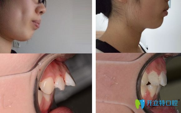濟(jì)南韓氏口腔牙齒矯正改善突嘴暴牙案例效果圖