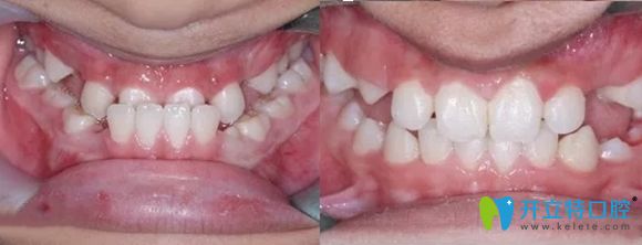 樂山英美口腔兒童“地包天”矯正案例圖