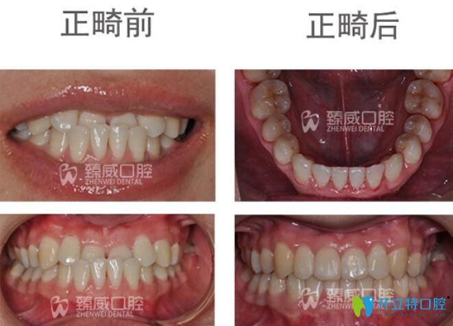 小姐姐矯正地包天后不僅牙齒變整齊了，臉型也有了很大的改變