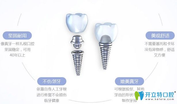 種植牙優(yōu)勢(shì)圖 種植牙優(yōu)勢(shì)圖