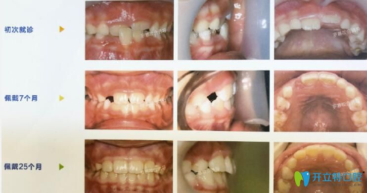 臻威口腔兒童羅慕咬合誘導早期干預矯正個別反頜牙齒案例