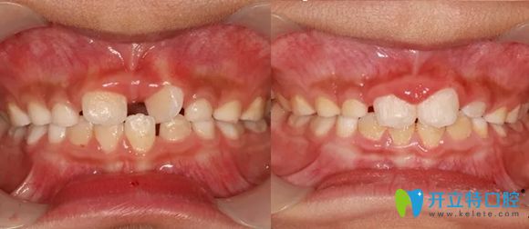 樂山英美口腔兒童扭轉(zhuǎn)牙矯正效果圖