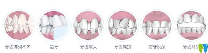 哪些牙齒情況需要做矯正圖示 哪些牙齒情況需要做矯正圖示