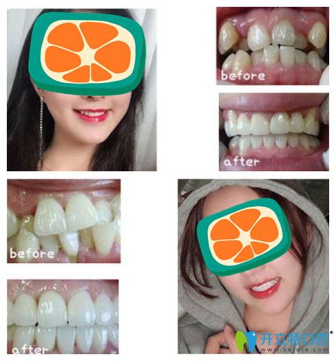 尚愛韓美口腔隱適美隱形矯正<span style=