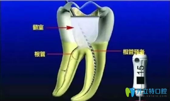 牙齒根管治療科普圖