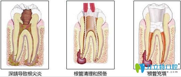 顯微根管治療5000多元!誰(shuí)能告訴我牙齒根管治療為什么那么貴