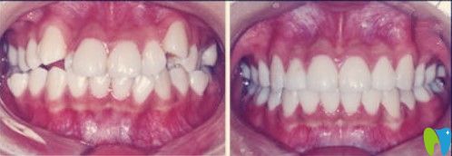 北京維嘉口腔虎牙矯正案例圖