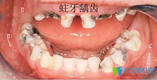 蛀牙爛到牙神經(jīng)會(huì)自發(fā)疼痛