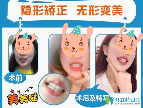 義烏傅氏口腔隱形矯正案例效果怎么樣