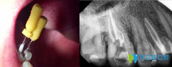 根管治療后的X線片影像圖