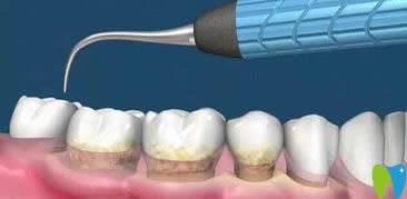 李雪醫(yī)生科普洗牙的好處有哪些 李雪醫(yī)生科普洗牙的好處有哪些