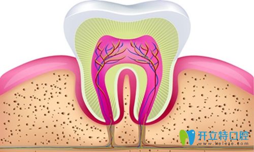牙齒爛到神經(jīng)就需要進(jìn)行殺神經(jīng)也就是根管治療