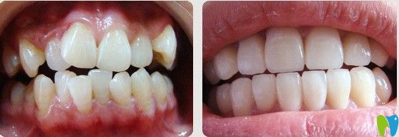 維嘉口腔牙齒不齊擁擠矯正效果圖