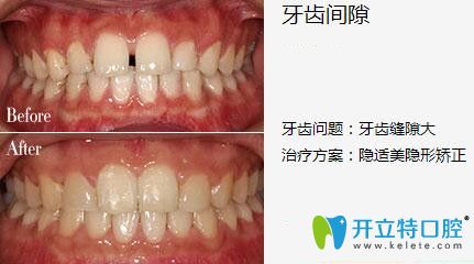 我在深圳弘和口腔做隱形矯正前后照片 我在深圳弘和口腔做隱形矯正前后照片