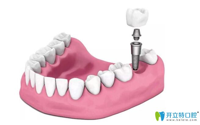 牙齒缺失可以使用烤瓷牙也可以用種植牙