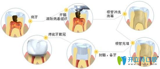 昆明尚愛韓美口腔盧玉瑩介紹根管治療的優(yōu)勢