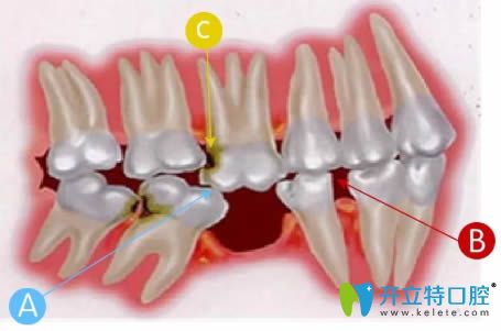 牙列缺損示意圖