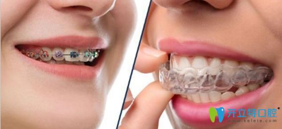 選鋼絲牙套或隱形牙套要因個人情況而定