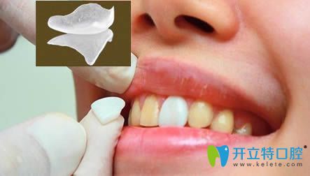 王巍科普數(shù)字化牙齒貼面的優(yōu)勢(shì)