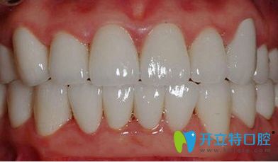 全瓷牙冠示意圖
