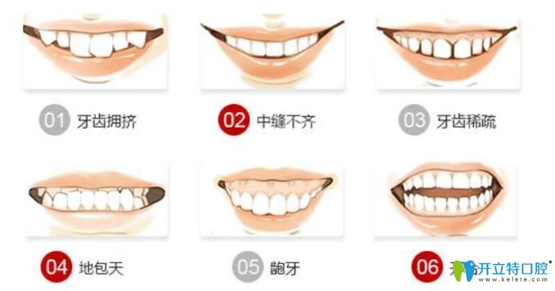 牙套帶多久與牙齒畸形程度有關(guān)