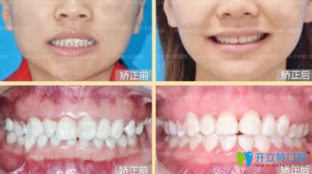 中諾口腔前牙深覆蓋案例圖