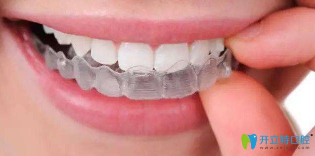 隱形牙套圖