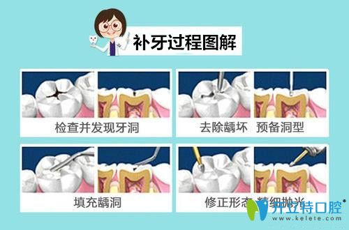 先了解補(bǔ)牙材料150和300的區(qū)別,再確定補(bǔ)牙用什么材料好