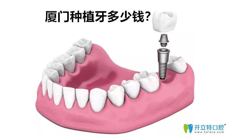 廈門種植牙多少錢？剛整理的廈門種植體品牌價格表供參考