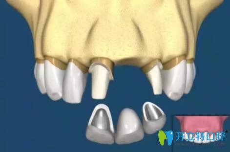 烤瓷牙修復(fù)