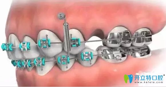 暑假做牙齒矯正有足夠的適應時間