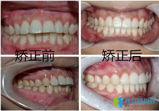隱適美隱形矯正齙牙效果