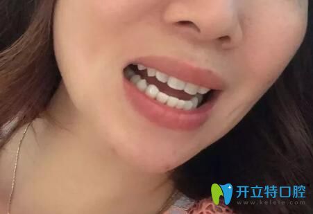 我在<!--<i data=20240703-sp></i>-->口腔做牙齒矯正后效果 我在<!--<i data=20240703-sp></i>-->口腔做牙齒矯正后效果