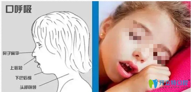 長期口呼吸對面部的影響圖示